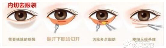 長沙華韓華美內(nèi)路法去眼袋