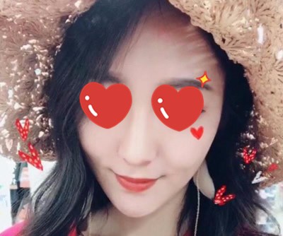 找北京壹加壹整形張綠峰醫(yī)生做的鼻綜合隆鼻 看效果怎么樣