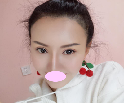 北京壹加壹張綠峰切開(kāi)雙眼皮案例 我割雙眼皮2個(gè)月恢復(fù)過(guò)程