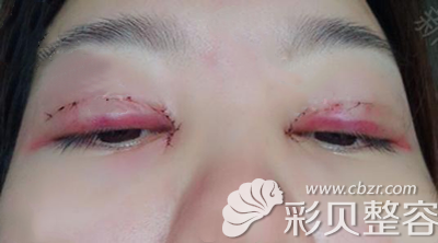 雙眼皮手術(shù)第四天超腫的眼睛