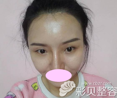 北京壹加壹張綠峰醫(yī)生做雙眼皮之前
