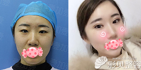 北京壹加壹丁洪如切開雙眼皮前后對比圖