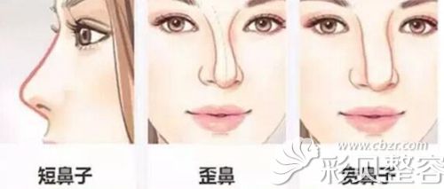 短鼻歪鼻和寬鼻的鼻型