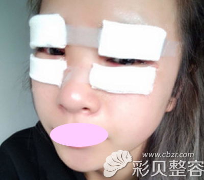 壹加壹醫(yī)美張綠峰做切開雙眼皮后