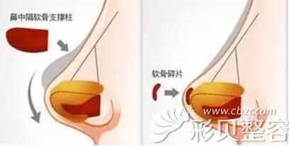 長沙華韓華美自體軟骨隆鼻示意圖