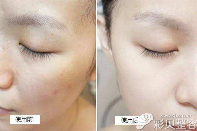北京柏麗張繼平案例圖前后對比看效果