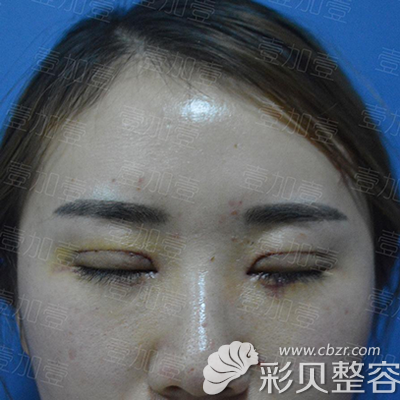壹加壹丁洪如切開雙眼皮四天后