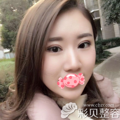 丁洪如做雙眼皮半個月后樣子