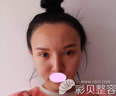 北京壹加壹切開雙眼皮手術(shù)七天后