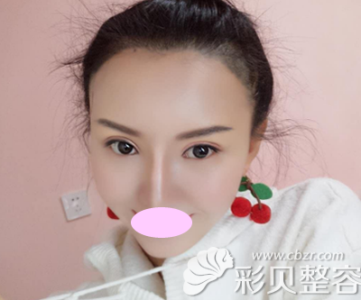 張綠峰做的雙眼皮兩個(gè)月后效果
