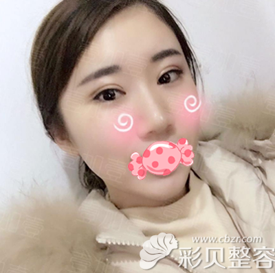 切開雙眼皮后兩個月圖片
