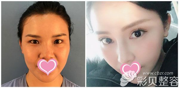 安琪整形醫(yī)院切開雙眼皮+開眼角案例效果