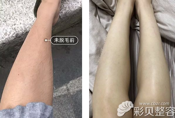 海南韓美李雪主任小腿冰點(diǎn)脫毛效果案例