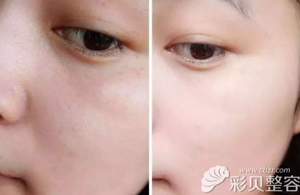 海南韓美臉部打前后效果對比圖片