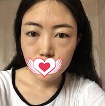 我找北京紫潔王春燕做內(nèi)切去眼袋手術(shù)后神秘的隱藏了年齡