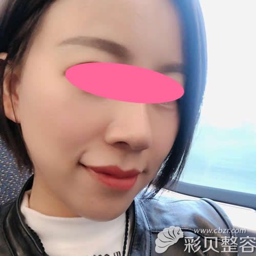 渭南德爾美客閻棣給我做自體脂肪填充全臉+肋軟骨隆鼻術(shù)后2個(gè)月效果圖