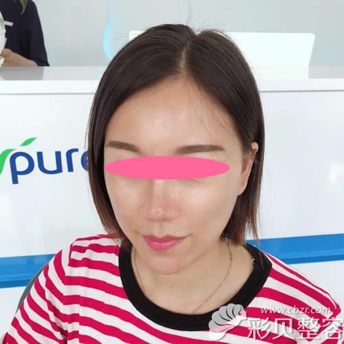 渭南德爾美客閻棣給我做自體脂肪填充全臉+肋軟骨隆鼻術(shù)后第28天效果