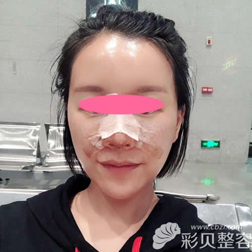 渭南德爾美客閻棣給我做自體脂肪填充全臉+肋軟骨隆鼻術(shù)后第1天