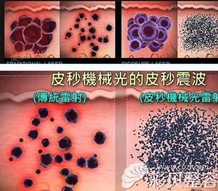 蜂巢皮秒激光可以將色素?fù)羲槌杉?xì)沙狀