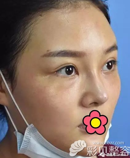 立方整形王樹立自體脂肪填充全臉第7天圖片