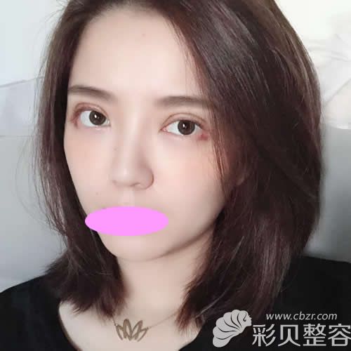 深圳恩吉娜陸華院長給我割的7.5mm雙眼皮術(shù)后第3天樣子