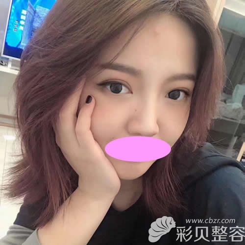 深圳恩吉娜陸華院長給我割的7.5mm雙眼皮術(shù)后第32天效果