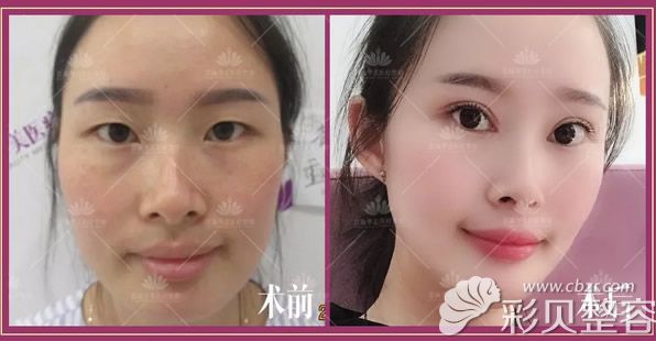 恩施華美樊輝華醫(yī)生全切雙眼皮第七天拆線前后效果對比