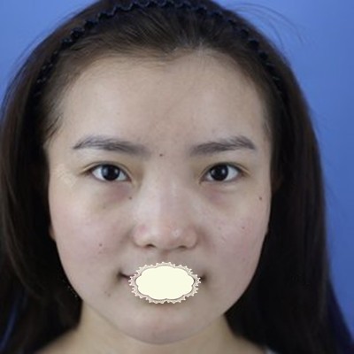 福州渙美樂(lè)鳳亮膨體隆鼻案例教你懂蒜頭鼻塌鼻梁怎么修復(fù)