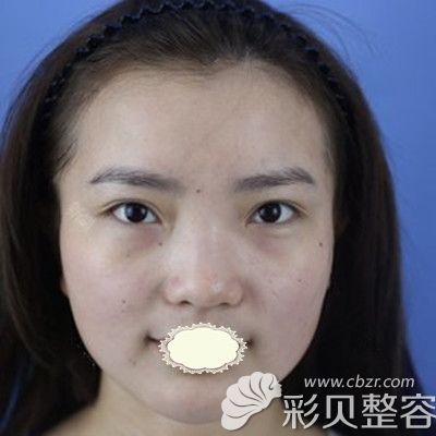 福州渙美醫(yī)療整形醫(yī)院樂鳳亮醫(yī)生做膨體隆鼻術(shù)前照