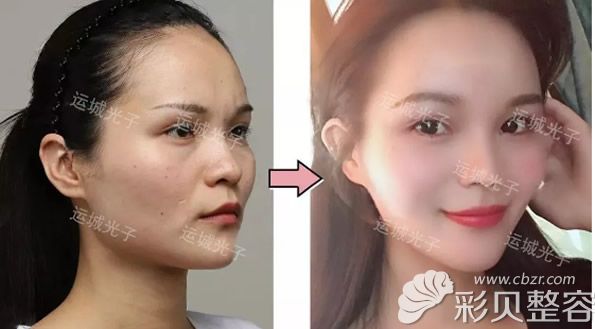 運城光子高晨濤全臉脂肪填充效果怎么樣