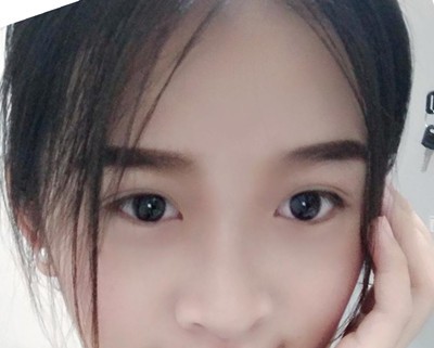 展示找鷹潭美嘉胡文瑜做定點雙眼皮1個月恢復圖看眼值高低