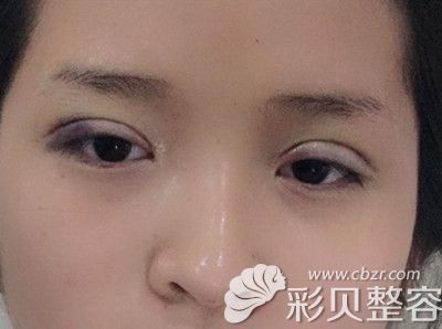 鷹潭美嘉醫(yī)美胡文瑜醫(yī)生韓式定點雙眼皮術(shù)后3天恢復(fù)圖
