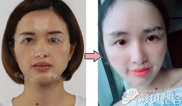 運城光子赫睿鵬全臉脂肪填充案例