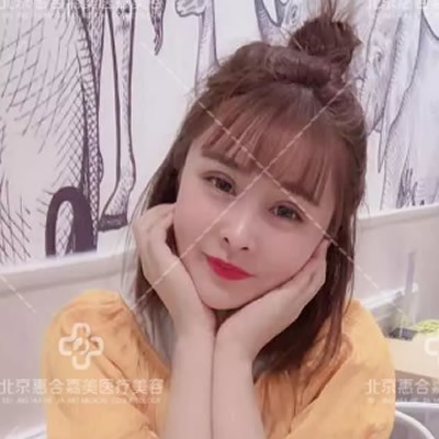 北京惠和嘉美齊敏做雙眼皮咋樣?看我內(nèi)雙糾結(jié)10年后的蛻變