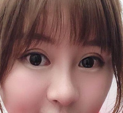 找北京惠合嘉美胡俊峰做假體隆鼻+耳軟骨墊鼻尖后成功變美
