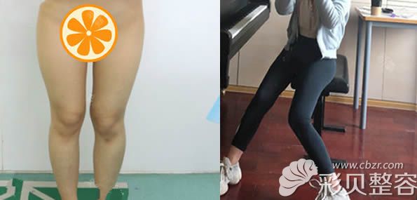 池州悅美劉強(qiáng)主任做的大腿吸脂案例效果