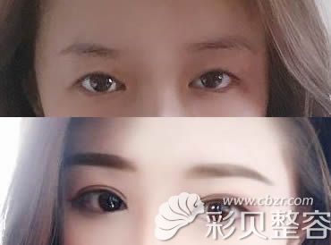 池州悅美劉強(qiáng)主任做的雙眼皮+開眼角案例效果