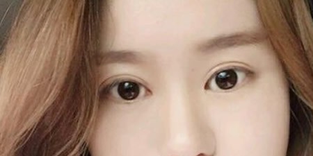 看過(guò)許昌麗娜整形價(jià)格表 我去醫(yī)院做了7毫米全切雙眼皮手術(shù)
