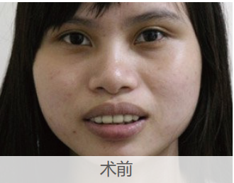 GA精準數(shù)字化正畸技術(shù)-齙牙矯正案例