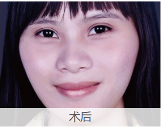 GA精準數(shù)字化正畸技術(shù)-齙牙矯正案例