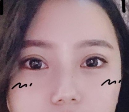 中山韓妃李光琴眼部修復.甩掉我雙眼皮術后倆眼不一樣心病