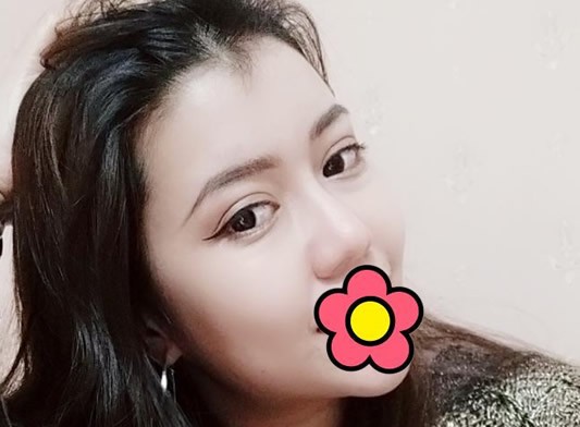 找烏魯木齊黎美許黎全切雙眼皮6個(gè)月后 還想做假體隆鼻手術(shù)