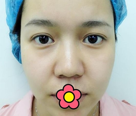 找烏魯木齊黎美許黎全切雙眼皮6個(gè)月后 還想做假體隆鼻手術(shù)