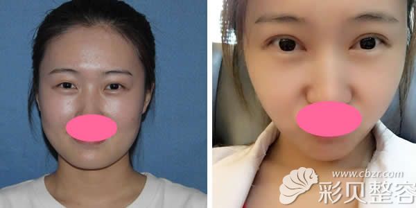 深圳陽光整形朱黎明醫(yī)生定制靈動雙眼皮真人案例效果 深圳陽光整形朱黎明醫(yī)生定制靈動雙眼皮真人案例效果