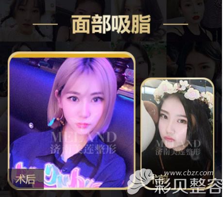 濟(jì)南美蓮韓旭醫(yī)生面部吸脂案例