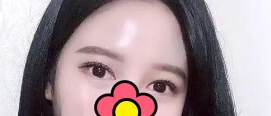 新鄉(xiāng)做雙眼皮哪家醫(yī)院好 芳藝喬長(zhǎng)順割雙眼皮40天很自然哦