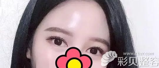 新鄉(xiāng)芳藝割雙眼皮三個月的恢復效果怎么樣