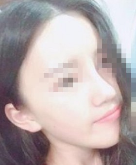 記錄我在韓國(guó)will做的硅膠假體+耳軟骨隆鼻手術(shù)過(guò)程