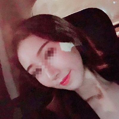 分享一則韓國寶士麗自體脂肪填充全臉真實(shí)案例