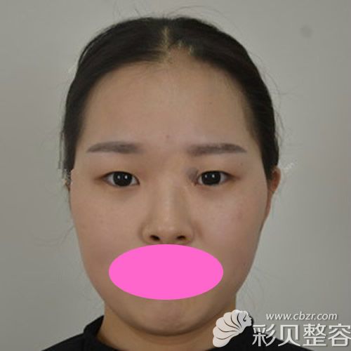 沒找蚌埠美萊塢張迪醫(yī)生割7mm雙眼皮+開眼角術前照片